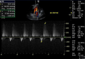 Aortic insufficiency in a dog with systemic hypertension