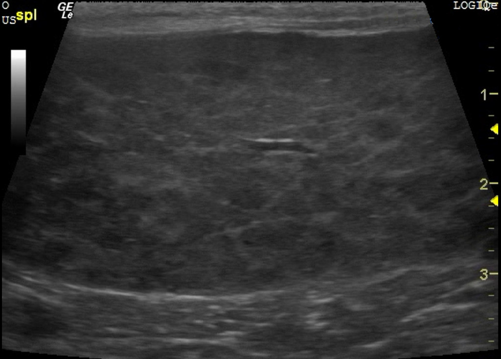 Abdominal Ultrasound