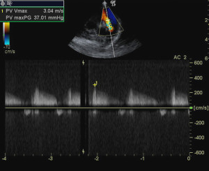 CW doppler in same patient showing PI velocity of 3 m/s, pulmonic insufficiency velocity greater than 2.2 m/s is generally considered to be diagnostic for diastolic pulmonary hypertension.